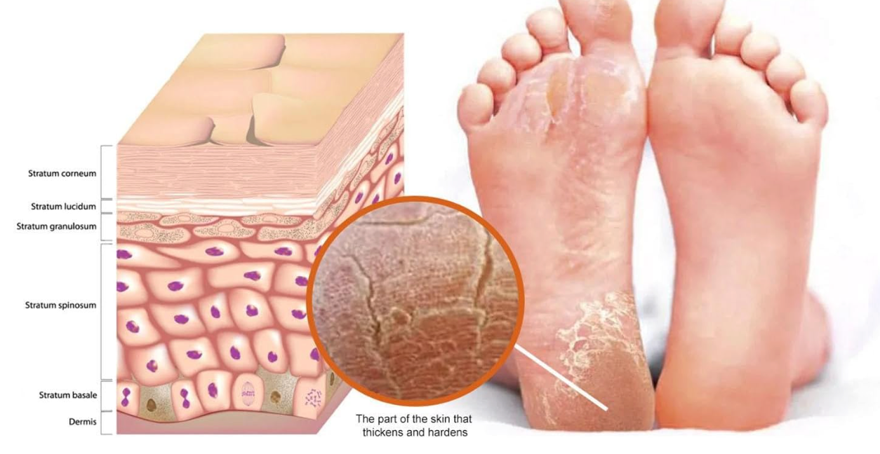 ByeCallus - Spray Exfoliante para el Cuidado de los pies - Dile Adiós a los Callos + Envio Gratis