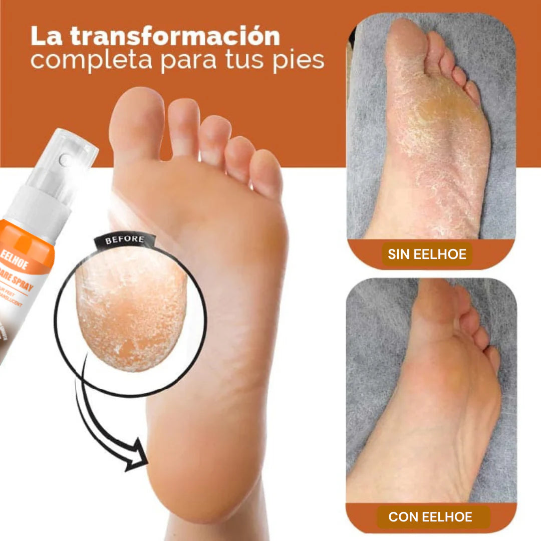 ByeCallus - Spray Exfoliante para el Cuidado de los pies - Dile Adiós a los Callos + Envio Gratis