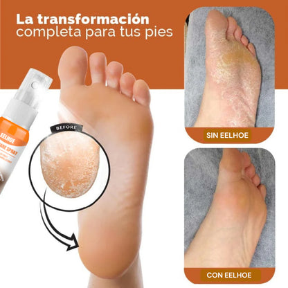 ByeCallus - Spray Exfoliante para el Cuidado de los pies - Dile Adiós a los Callos + Envio Gratis